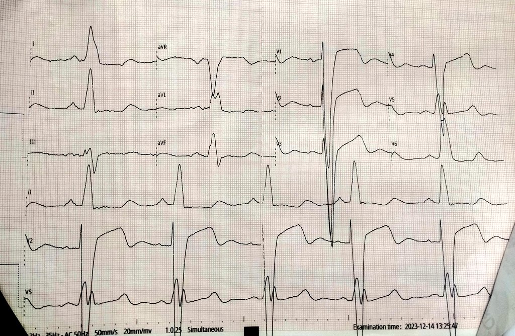 55Yr/F patient with sudden chest pain, breathlessness,  echocardiography may show to  global hypokinesia EF - 25%  and lv severely dilated . What is ecg finding ⁉️