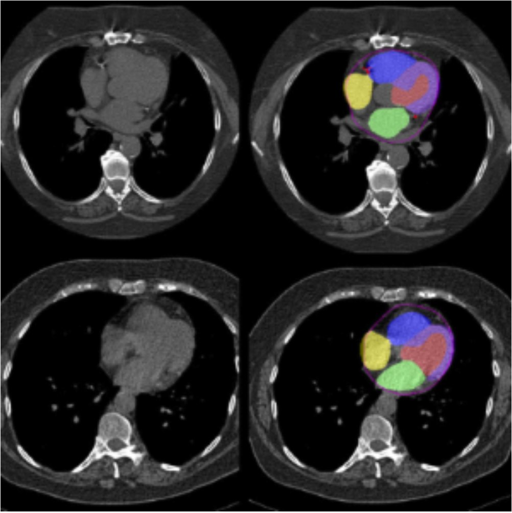 AI Method Could Identify High-Risk Cardiac Patients in Routine CT Scans Learn more ➡️ bit.ly/3RftWsD @CedarsSinai @NatureComms #RadNews #AI #Radiology #Cardiopulmonary #CT Scan