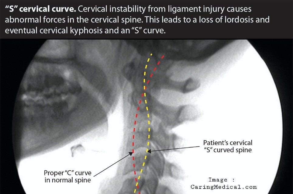 S curve vs C curve in cervical spine. Cervical instability from ligament injury causes abnormal forces in the cervical spine. This leads to a loss of lordosis (and subsequently loss of C curve) and eventual cervical kyphosis and an 'S' curve. From: CaringMedical