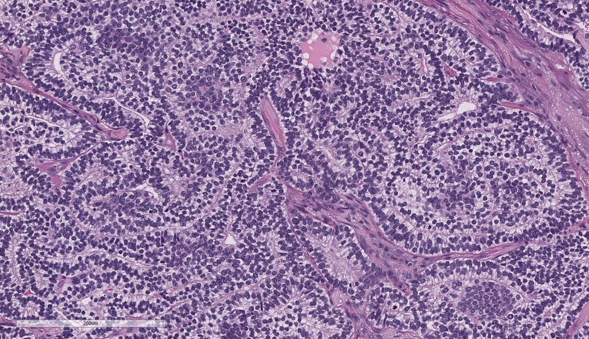 Fetal Adenocarcinoma of Lung, Low-Grade 🔬 Architecture: Glandular, papillotubular, cribriform Cytology: Pseudostratified columnar cells with supra- or subnuclear glycogen vacuoles (piano keys!). Round uniform nuclei. Nuclear beta-catenin (vs. membranous in HG) #pathology