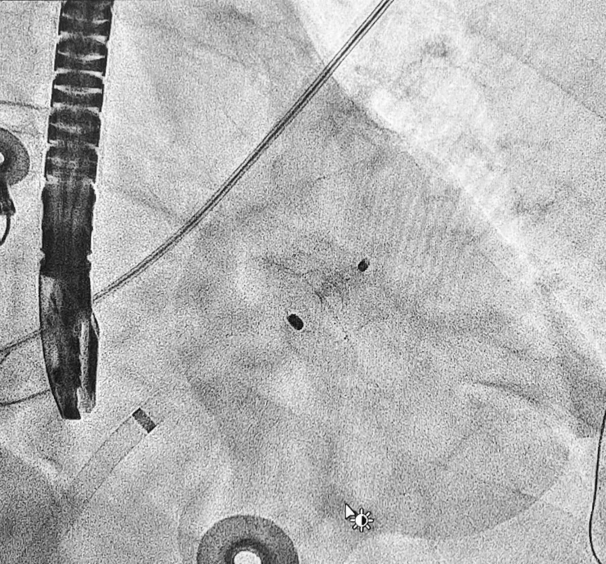 Adolfo Fontenla (@adolfofontenla) on Twitter photo La FA afecta a calidad de vida no solo por sus síntomas, también por los problemas asociados a la ACO🩸
En <a href="/CardioQuironMad/">CardioQuironMadrid</a> integramos ablación de VVPP y cierre de orejuela en el mismo acto, como por ejemplo en este redo de FA en paciente con sangrados frecuentes👇🏼 La FA afecta a calidad de vida no solo por sus síntomas, también por los problemas asociados a la ACO🩸
En <a href="/CardioQuironMad/">CardioQuironMadrid</a> integramos ablación de VVPP y cierre de orejuela en el mismo acto, como por ejemplo en este redo de FA en paciente con sangrados frecuentes👇🏼