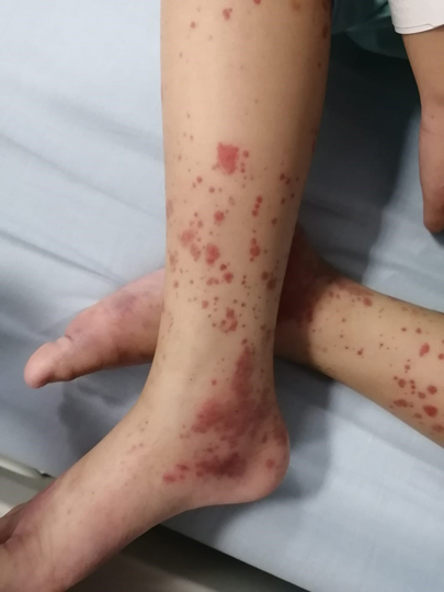 A 6-year-old boy presents with a characteristic rash on his legs. He recently had a upper respiratory tract infection that has since resolved. He's noticed that his urine is turning red as well. Exam shown below. Diagnosis? Learn more and generate your own FREE board questions