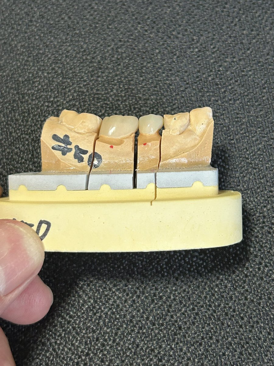 保険適用のCADCAM冠です。
保険診療でも金属を使わない白い歯が作れるようになってきました。
長所も短所もありますので治療を受けられる際にしっかりと説明を受けてください。