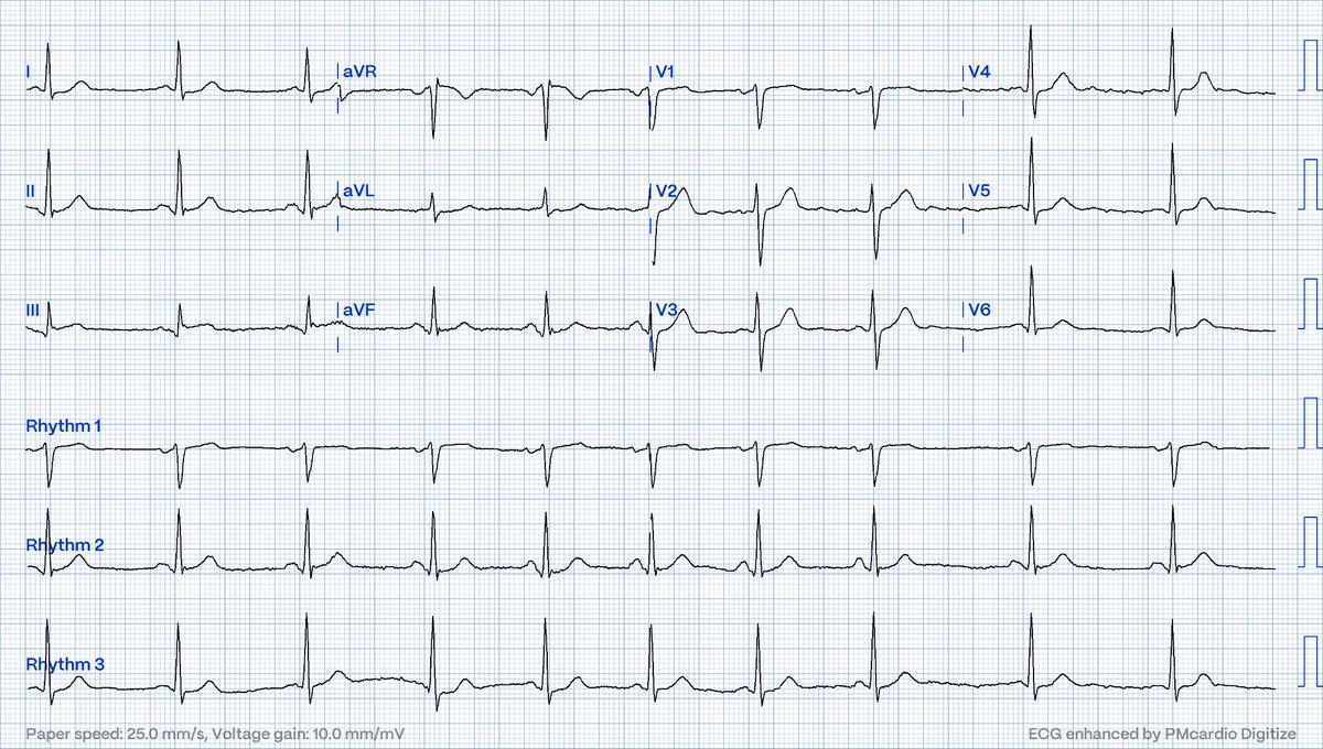 An undergraduate who is an EKG tech sees something. The computer calls it completely normal. How about the physicians? hqmeded-ecg.blogspot.com/2024/05/an-und…