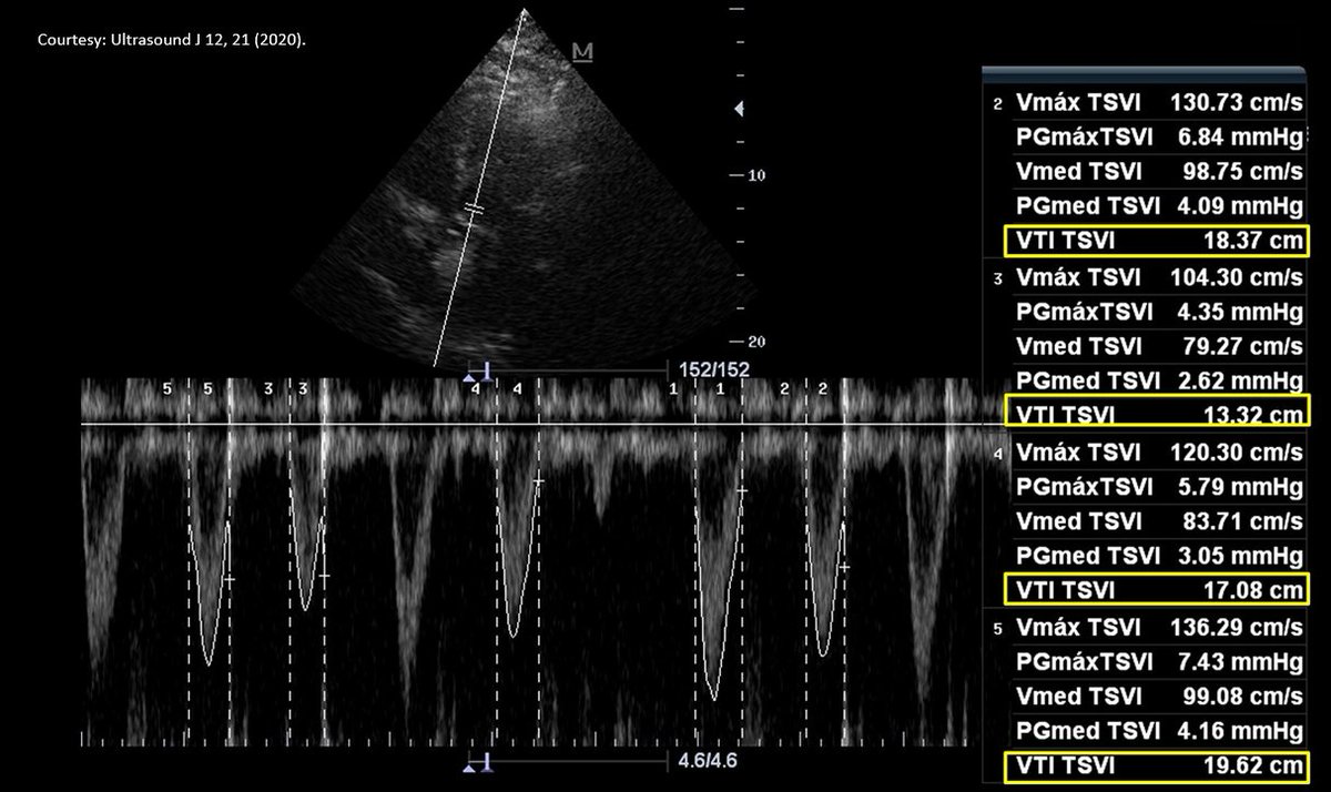 ⚠️LVOT VTI tip - don't forget to average multiple envelopes in atrial fibrillation to account for beat-to-beat variation. #POCUS #FOAMed #Nephpearls
