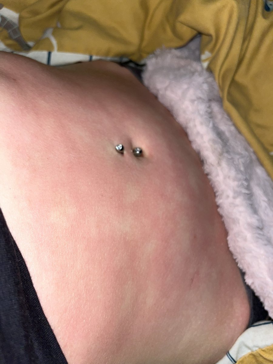 a part of chronic pain no one talks about
✨ hot water bottle burns✨
this is my skin atm because i’m having a flare up and it’s the only thing that helps a little bit.
i used to hate it but now i think it’s kinda pretty
#endometriosisawareness 🩷