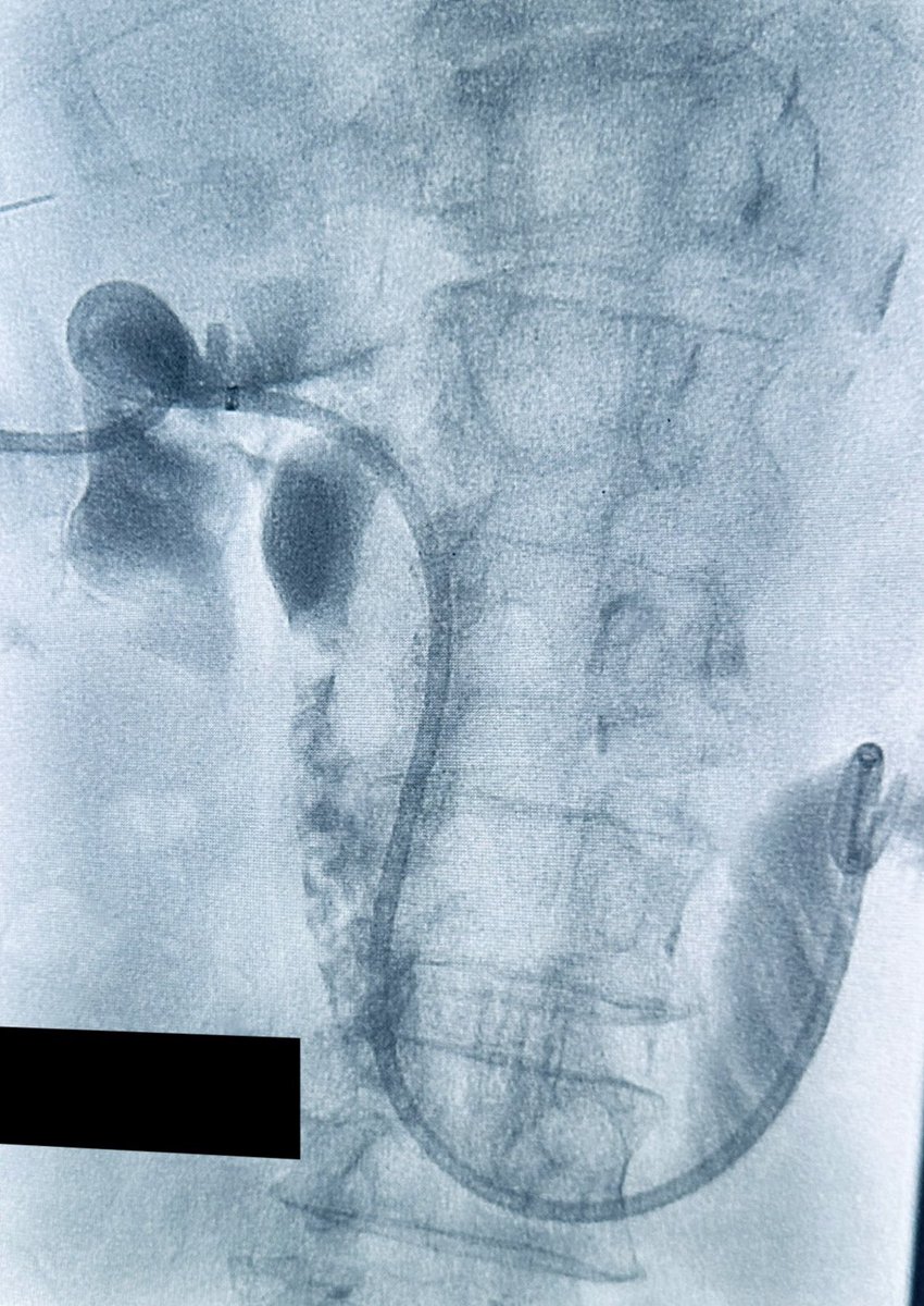 For those that use GB access to place biliary ext- internal drain, what’s your catheter of choice? Biliary vs NU catheter?? Failed #ERCP, #CBDstone. Failed #PTC (minimal distention) @keithppereira @saherssabri @SDhandMD @skohoro @brianchiong @CHICKVIR @ChengaziMD @IR_Doctor