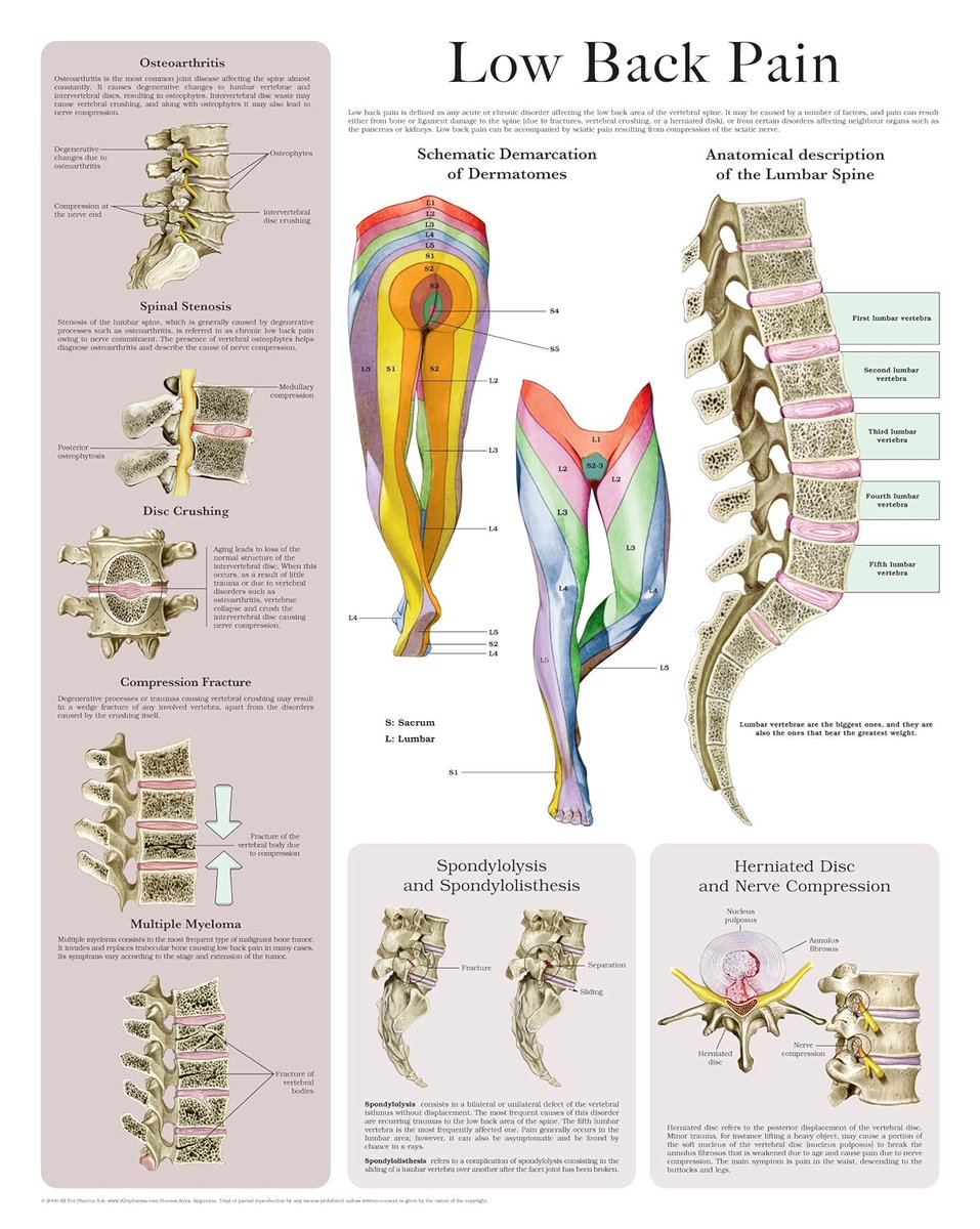 Lumbar spine = lower back 'LOW BACK PAIN' is classified as ACUTE (a few days to a few weeks) & CHRONIC (lasts for more than 3 months & often gets worse). Common causes of low back pain & schematic demarcation of dermatoms demonstrated 👍 Poster from: hc-healthcomm.com