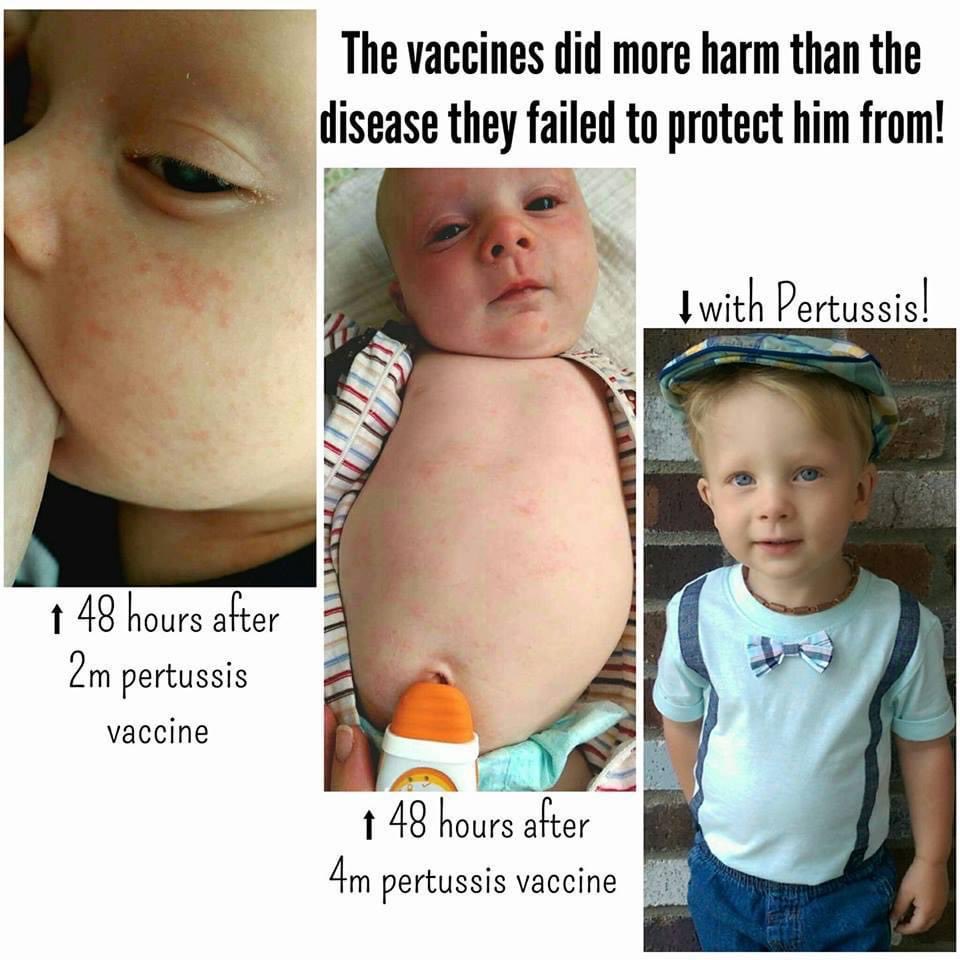 “This mom's baby had a bad reaction to the pertussis vaccine. But the doctor kept insisting on it. 
Then, despite being fully vaccinated, he ended up getting pertussis. It's not a good vaccine, folks. 
The efficacy profile is disappointing--it seems that the bacteria that causes