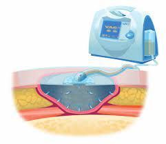 Proteomics changes after negative pressure wound therapy in diabetic foot ulcers #NPWT #DiabeticFoot #WoundHealing diabeticfootonline.com/2021/10/10/pro… diabeticfootonline.com/2021/10/10/pro…