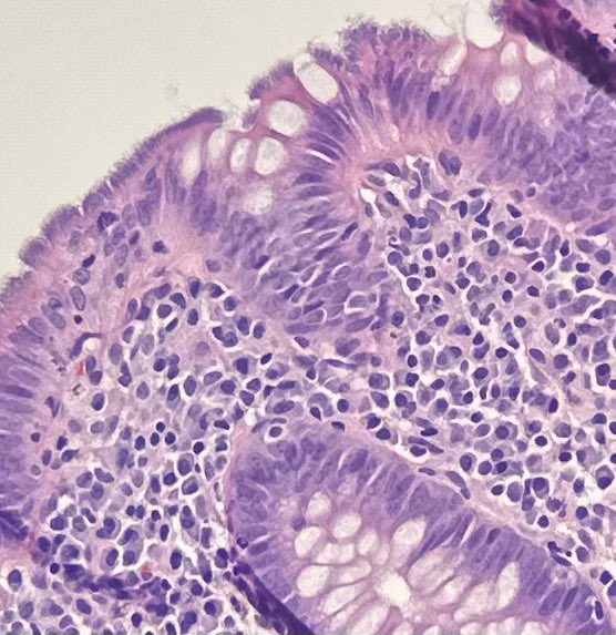 Intestinal spirochetosis 🌀 Colonization of the colonic epithelium by filamentous nontreponemal anaerobic spirochetes of the Brachyspira species. #pathology #PathTwitter #PathX