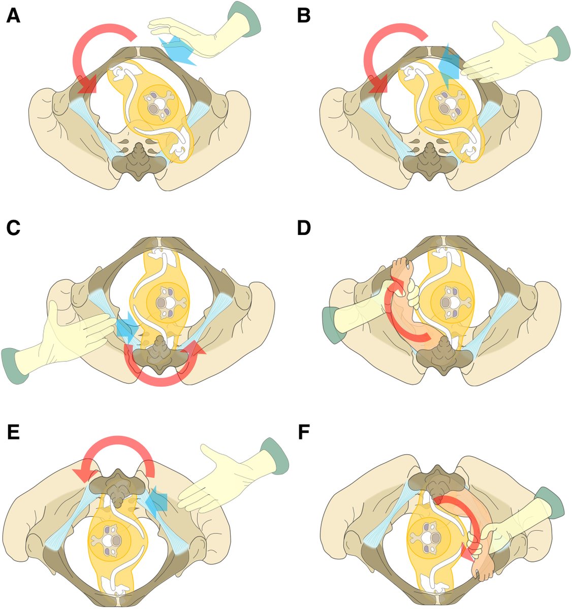 AJOG Expert Review in Labor: A critical evaluation of the external and internal maneuvers for resolution of shoulder dystocia - Approaches of the accoucheur’s hand in different maneuvers ow.ly/RLiV50RuyXy #obgyn