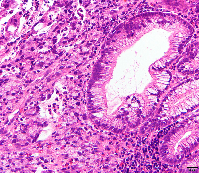 Stomach biopsy, what is your diagnosis? #GIpath #Pathtweet #PathX