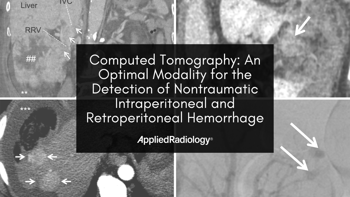 Acute nontraumatic abdominopelvic hemorrhage is a medical emergency that requires prompt diagnosis; imaging is often crucial to localize the source and extent of bleeding. Read more ➡️ bit.ly/3wFyy46 #RadEd #MedEd #Radiology #Imaging #CT