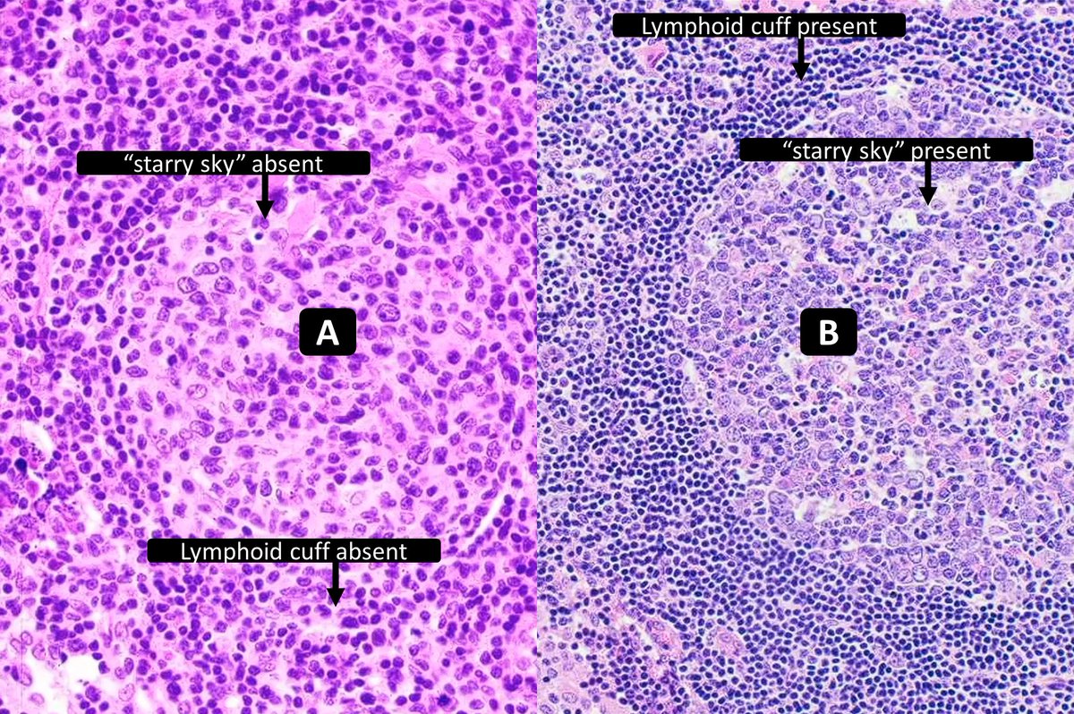 A or B = follicular lymphoma? #HemePath #PathTwitter #Pathology