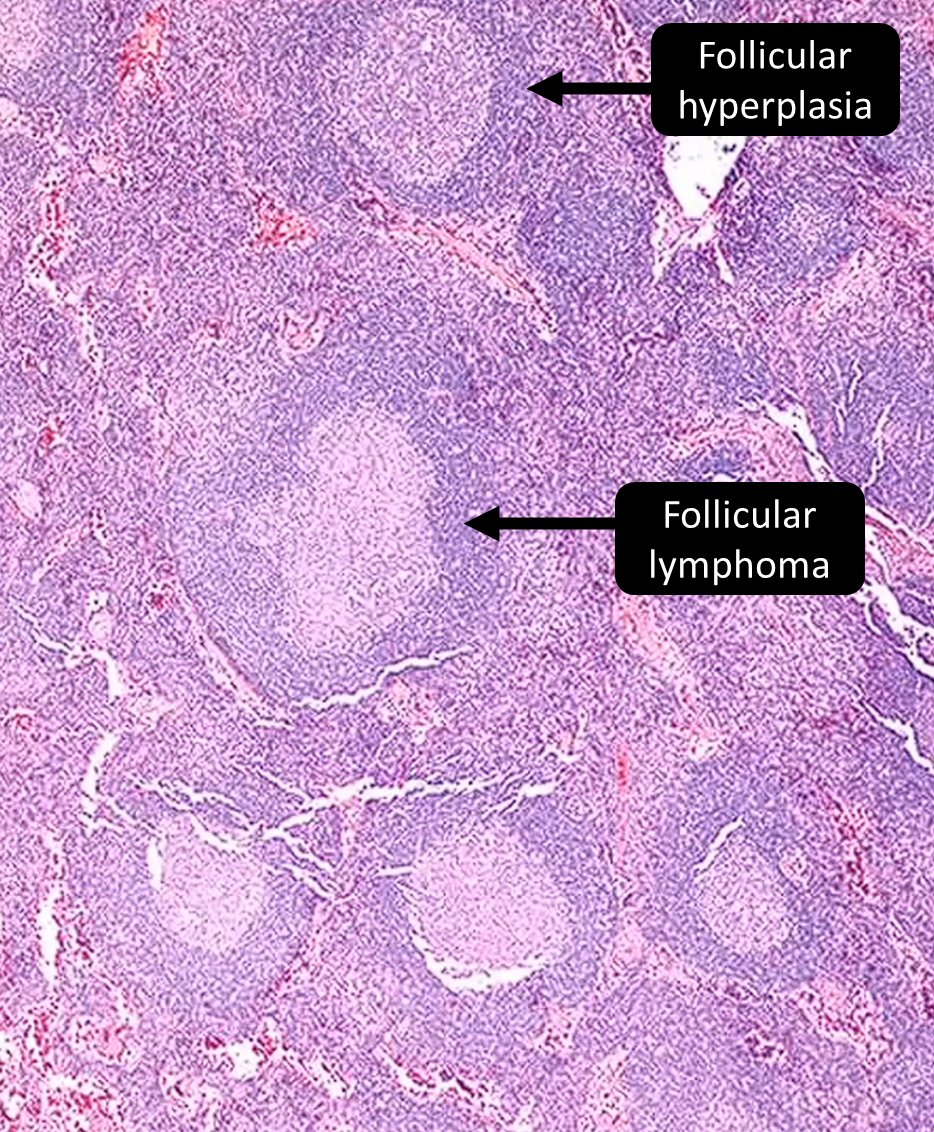 Follicular lymphoma in situ is seen in A. Lymphomas show loss of architecture, including the absence of 'starry sky' (i.e., tingible body macrophages) or a lymphoid cuff (mantle zone). The anti-apoptotic molecule BCL2 is normally turned off in the germinal center, however,