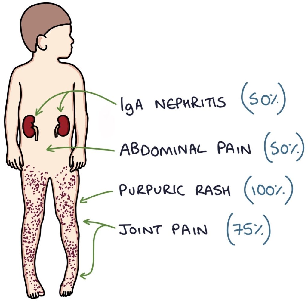 @neuralconsult Henoch-schonlein purpura(IgA vasculitis) The classic triad of clinical symptoms and signs includes purpuric rash, abdominal cramping, and hematuria.