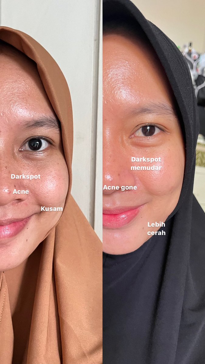 glowinbeautyy's tweet image. Awalnya cuma fomo aja karena ini lagi trending, eh surprisingly ini BAGUS BANGET😭😭😭
Pantes sih viral dimana-mana bahkan sampe harus preorder dulu kalau beli, soalnya emang worth the hype 👌
Ini exfo terbaik sih, cocok buat pemula juga~