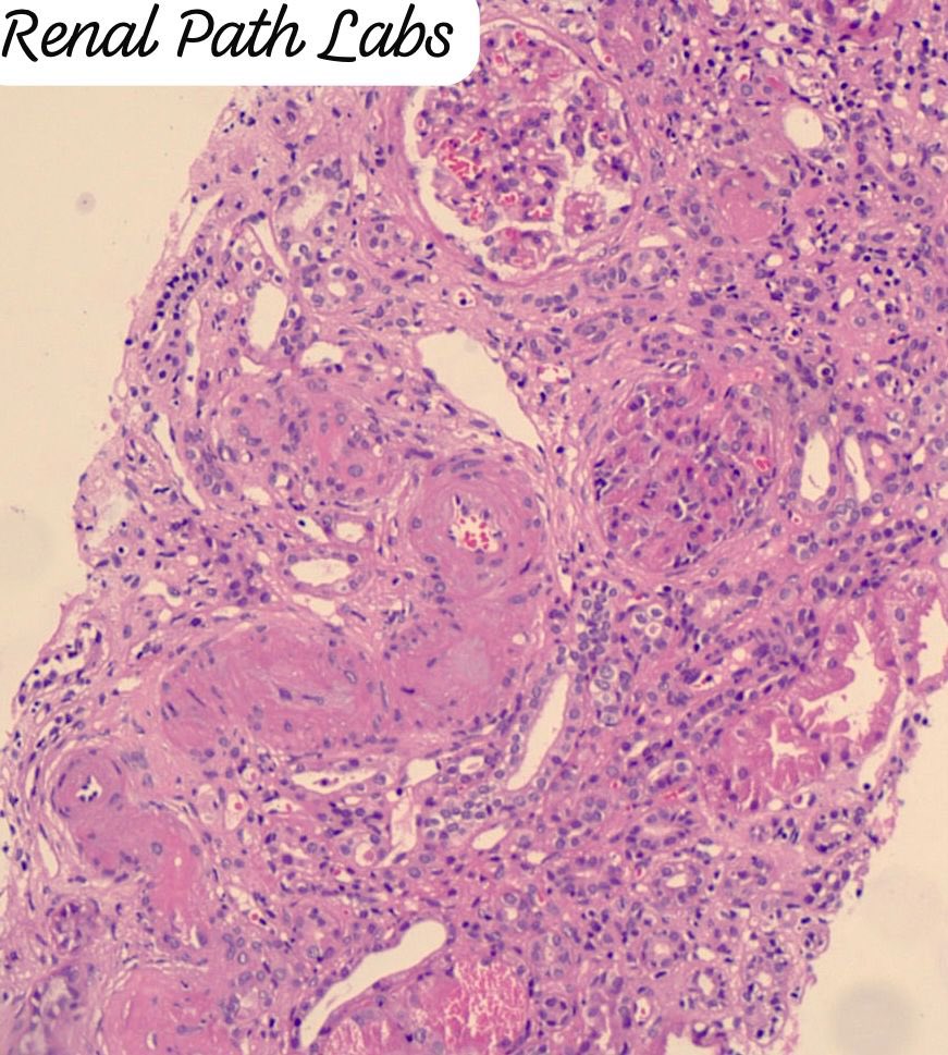 Whether it is IgAN, Tx biopsy or Hypertensive patient- you will search for it and you may find it in all! What is it??
#PathPuzzle #RenalPath #AskRenal #AskRenalPath #Nephtwitter #PathTwitter #PoojaMaheshwari