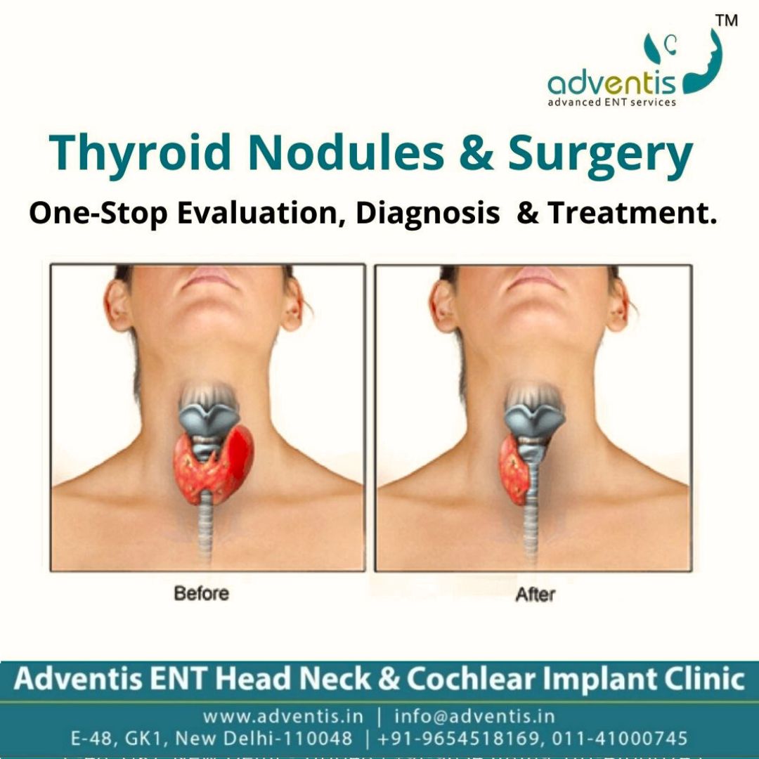 Adventisdelhi's tweet photo. Get a Minimally Invasive Thyroid Surgery at Adventis ENT & Cochlear Implant Clinic and make your way toward faster recovery and lower morbidity.
🔗https://t.co/TWIdwbf1DE
#AdventisClinic #AdventisENT #Care #ENTClinic #ENT #ThyroidSurgery #GoScarless #ThyroidProblem #Thyroid https://t.co/61mYjVbpUC