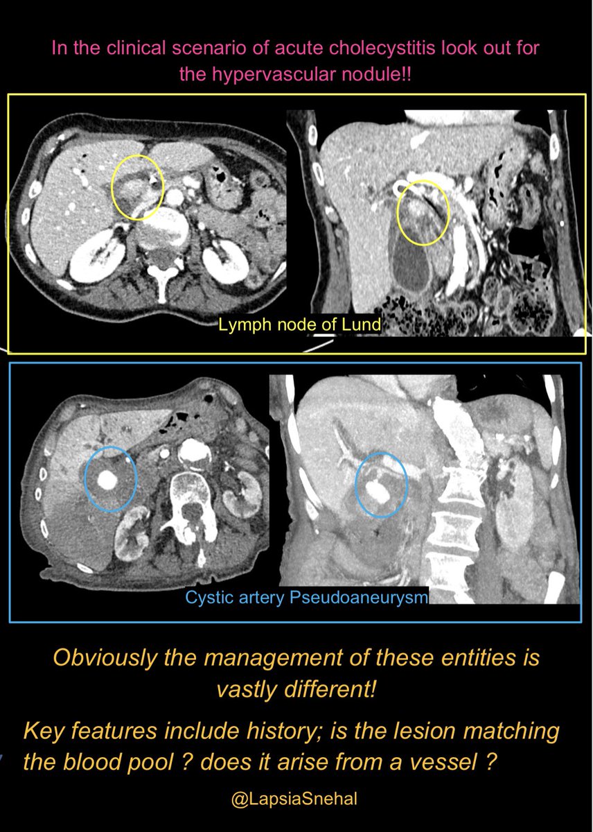 Two separate cases that at first glance can look very similar. Important to correctly identify because the treatment is vastly different 

#FOAMrad #FOAMed #meded  #radres #futureradres #medstudenttwitter #anatomy #frcr #surgery #radiology #radtwitter #medtwitter #hpb