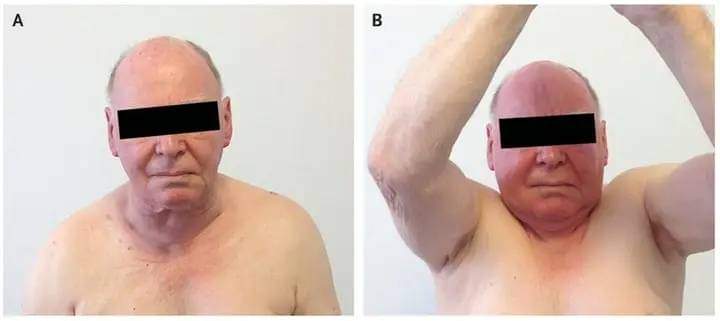 🍁𝘾𝙇𝙄𝙉𝙄𝘾𝘼𝙇 𝙌𝙐𝙄𝙕:

📙A 77yr ♂️with subclinical #hyperthyroidism & enlarged thyroid .When patient raised both arms, developed reversible facial congestion.

 Name of sign❓

A) Pemberton's sign
B) Rovsing sign
C) Homans sign
D) Cullen's sign

#medx
#medEd