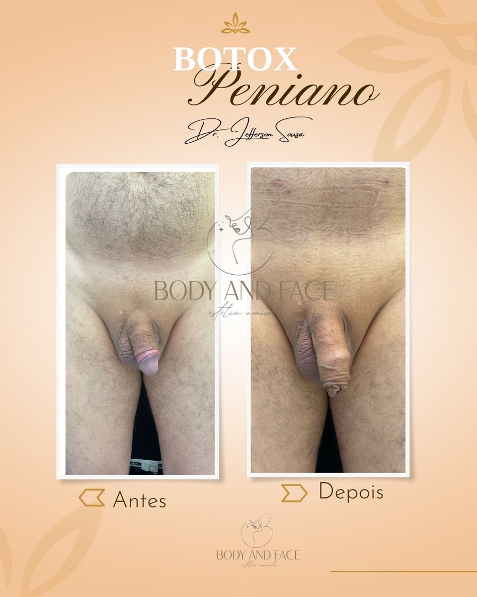 BodyAvancada's tweet photo. Harmonização íntima Masculina Preenchimento Peniano com Ácido Hialurônico na TECNICA HAM . Agende agora mesmo a a sua consulta.                                                             https://t.co/rXgaENzfYB https://t.co/SUdgxB2QUy