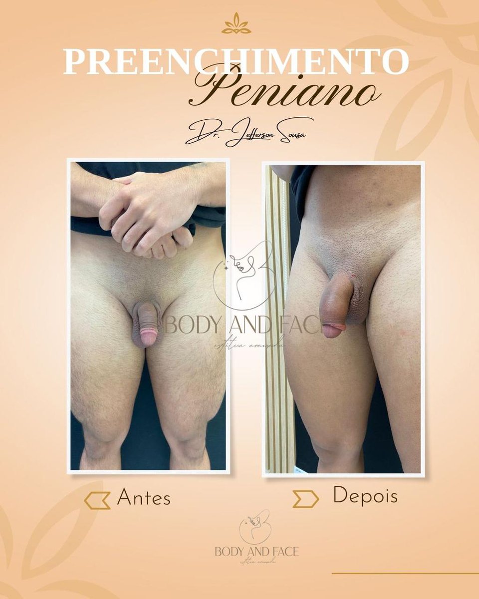BodyAvancada's tweet photo. Harmonização íntima Masculina Preenchimento Peniano com Ácido Hialurônico na TECNICA HAM . Agende agora mesmo a a sua consulta.                                                             https://t.co/rXgaENzfYB https://t.co/wsrVGNIsXj