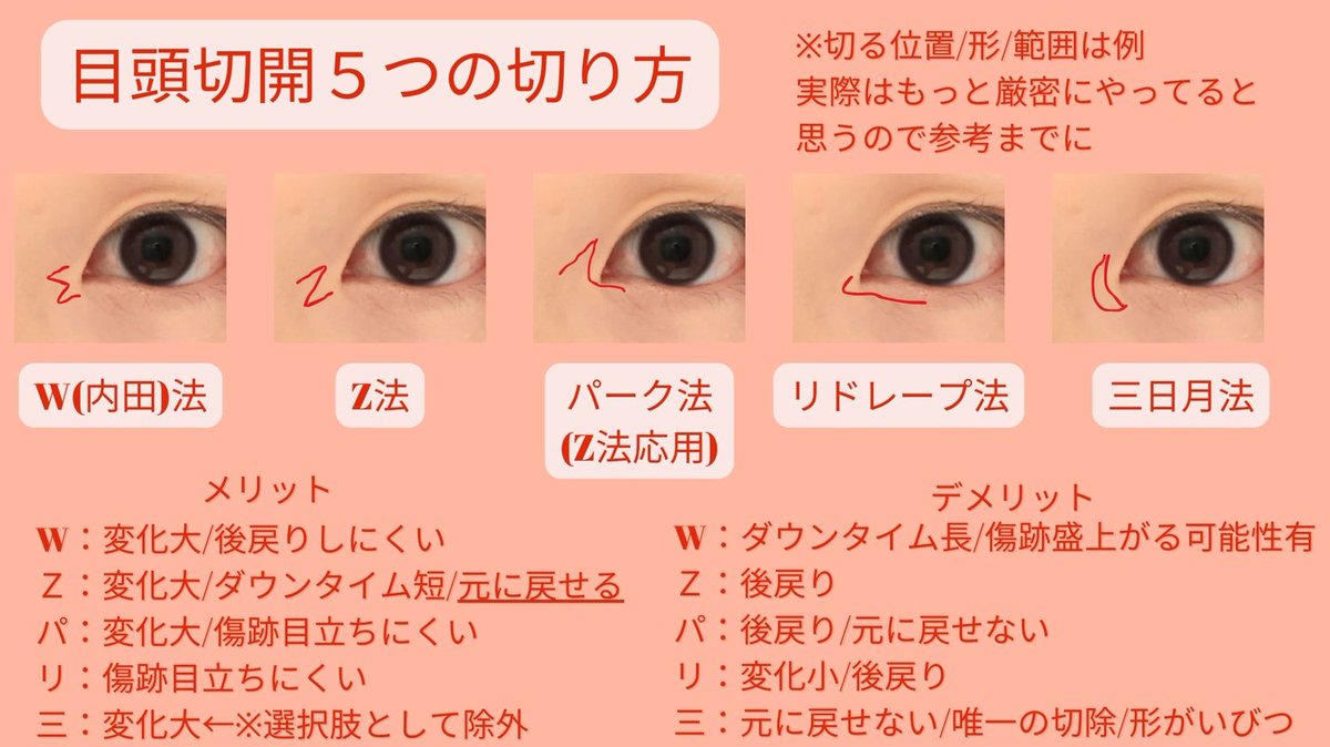COPPY1st's tweet photo. 【目頭切開】まとめ
・目頭切開はZ法かパーク法が無難
・好みの症例で選ぶべき

目頭切開はこれ！って言い切れない部分が多くて情報が曖昧だから参考までに…調べるきっかけになってくれたら！
理想の目にするには https://t.co/eOJIm4gxyY