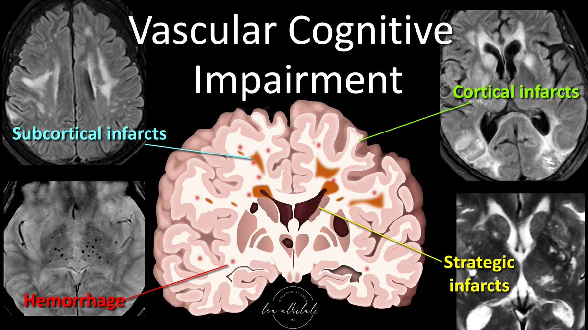 1/Having trouble remembering what you should look for in vascular dementia on imaging? Almost everyone worked up for dementia has infarcts. Which ones are important? Here’s a thread on the key findings in vascular dementia!