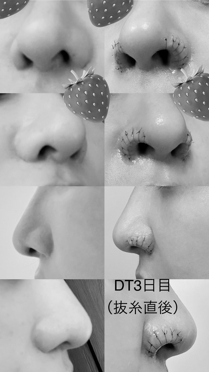 chibitaseikei's tweet photo. DT3日目（半分抜糸） https://t.co/K9PeilBwaE