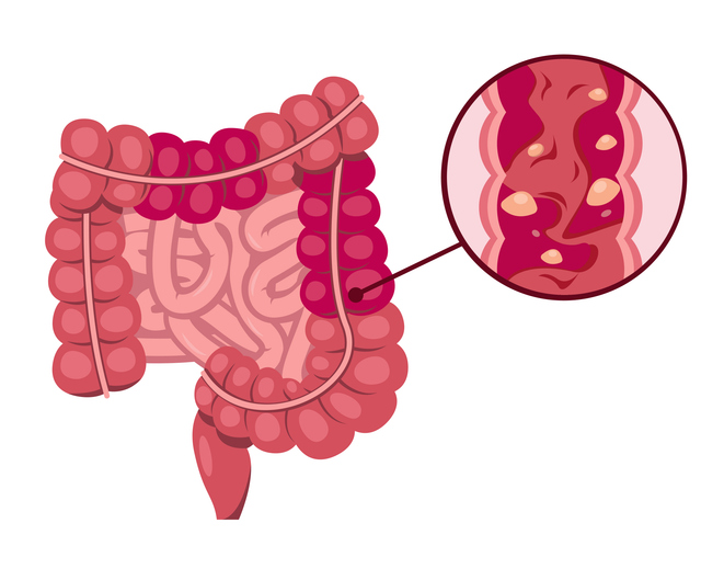 Living with Ulcerative Colitis?

Managing symptoms like abdominal pain and diarrhea can be challenging, but you're not alone. Our experienced team is here to provide personalized care and support to help you feel better. Visit givisit.com!
