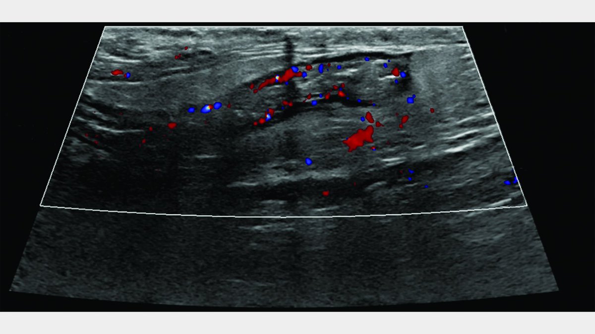 🩻 Case Study of the Week! Post your guess in the comments and check back on Friday to see if your diagnosis was correct! See all the case details, more images, and diagnosis ➡️ bit.ly/4bsvuHw #RadEd #Radiology #CaseOfTheWeek #RadRes #CaseStudy #COW #MedEd