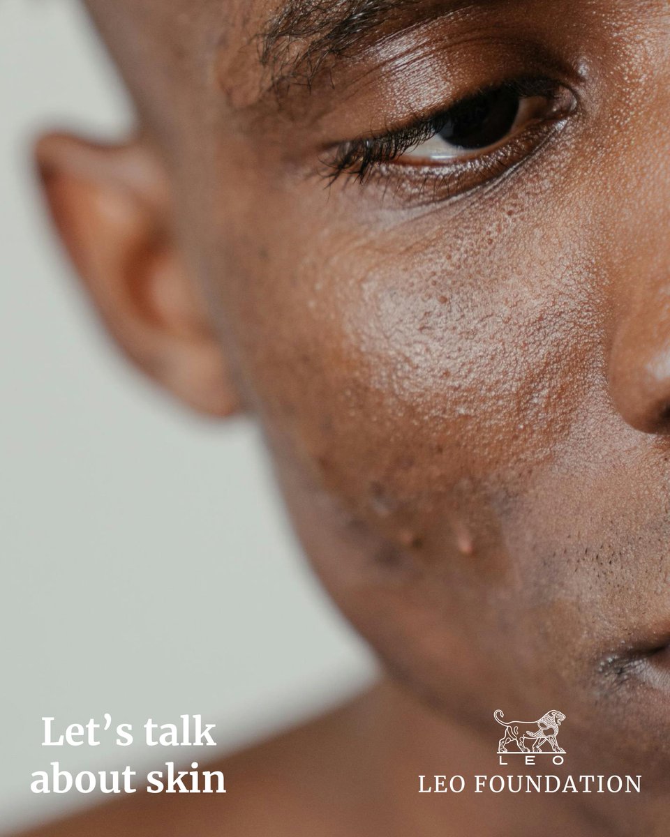 Did you know nearly everyone experiences acne? It happens when hair follicles get clogged by oil and dead skin cells, leading to pimples or zits. Contrary to common belief, #acne isn't caused by dirty skin or poor hygiene (and it's not contagious either). #LetsTalkAboutSkin