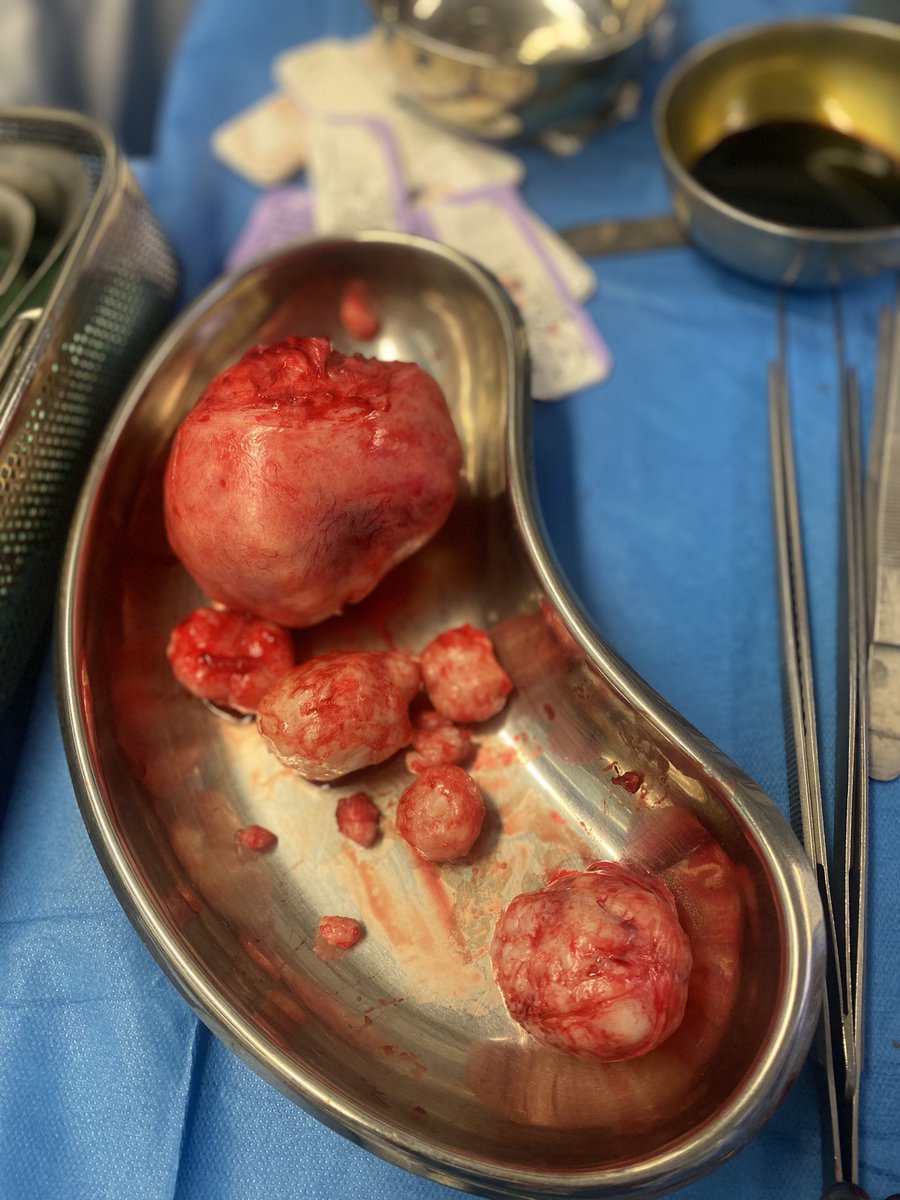 Meat balls or fibroids ? 🌚