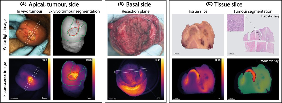 Online now: Fluorescence-guided surgery using cetuximab-800CW in patients with penile carcinoma doi.org/10.1111/bju.16…