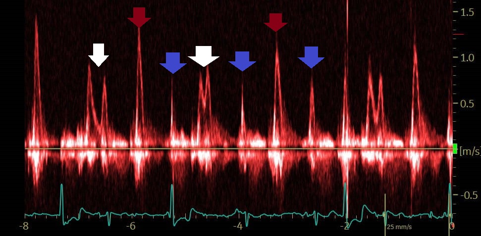 An elderly patient with fatigue. The mitral inflow is interrogated by PW Doppler. What findings are indicated by arrows?