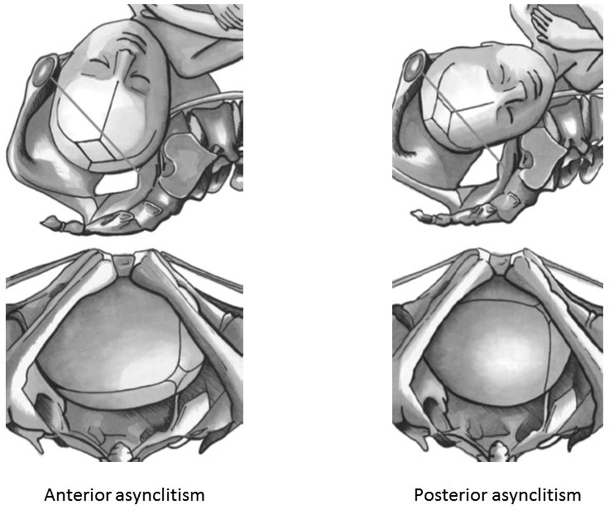 AJOG Expert Review in Labor: Sonographic evaluation of the fetal head position and attitude during labor - Schematic representation of the different subtypes of asynclitism ow.ly/hiiL50OufBV