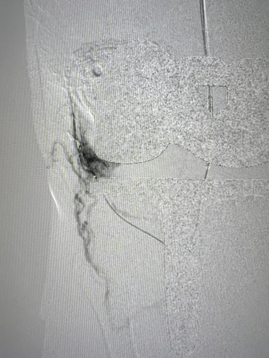 We have a poster in our clinic office that reads: “Interventional Radiology, it’s like surgery, but Magic” Making invisible recurrent selections into ~mm vessels highlights the #VIRad skillset @drochohan @IRtmke @iRadRock @linemonkeymd @smbracewell @DrChrisNicholas