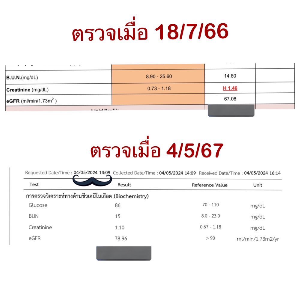 sorkorlao's tweet photo. สิ่งที่ซ้อ ภูมิใจที่สุดในตอนนี้คือ 🥰🥰
ทำให้ค่าไตของสามี ดีขึ้น 
จาก 67 --> 78.9

สามีซ้อ ค่าไตไม่ค่อยดี 
ค่าไต อยู่ที่ 60 กว่ามาตลอดหลายปี

ซ้อปรึกษาหมอ หมอบอกว่า 
ไตยังไม่เสื่อมมาก ยังเอากลับมาได้

ซ้อไม่อยากให้สามีไตเสื่อม หรือฟอกไต 
ทุกวันนี้ ซ้อพยามอย่างมาก 
ที่จะดูแล ฟื้นฟู ให้ไตสามีกลับมาดีขึ้นอีกครั้ง 

ทั้งหาหมอ หาข้อมูล ศึกษาหาข้อมูลเยอะมาก ว่าต้องทำยังไงให้ค่าไตของสามีดีขึ้น อาหาร การกิน การใช้ชีวิต life style และวิตามิน สำคัญมากๆ กับคนที่ไตมีปัญหา

ซ้อใช้เวลาเกือบปี ปรึกษาหมอ 
ดูแลโภชนาการ และทุกอย่างของสามี เหนื่อยมากๆเลยนะ ซ้อทำกับข้าวให้สามีไปกินที่ออฟฟิศทุกวัน ทั้งๆที่สังขารก็ไม่ค่อยไหว เพราะป่วย แต่ สุดท้าย 
ซ้อก็ทำได้ 

สามีซ้อก็กินวิตามินเช่นกันค่ะ กินวิตามินภายใต้การดูแลของหมอนะคะ 

และค่าไตเค้าดีขึ้น ถึงบอกว่าวิตามินไม่ได้ทำให้ตับพัง ไตเสื่อม ถ้าเลือกที่คุณภาพดีๆ และกินแบบถูกวิธี 

ค่าไตสามีซ้อขึ้นจาก 67 มาเป็น 78.9 ซ้อดีใจมาก และจะพยามทำต่อไป อยากให้สามี มีค่าไตเกิน 90 ให้ได้ 

อยากบอกทุกคนที่มีปัญหาไตเสื่อมว่า ถ้าเราดูแลดีๆ ทำถูกวิธี เราจะทำได้ค่ะ 

ร่างกายของเรา เราต้องดูแลนะคะ 
ถ้าเราดูแลเค้าดี เค้าจะกลับมาได้ค่ะ
ขอแค่อย่าท้อ สู้ๆนะคะ

อย่างที่บอก เรื่องการดูแลร่างกาย เป็นสิทธิส่วนบุคคล ใครเชื่อและสบายใจแบบไหน ก็ทำแบบนั้น 

ร่างกายของเรา เรามีสิทธิ์เลือกวิธีที่จะดูแลค่ะ ใครสะดวกแบบไหนก็ทำแบบนั้น ทำแบบที่ตัวเองสบายใจดีที่สุด