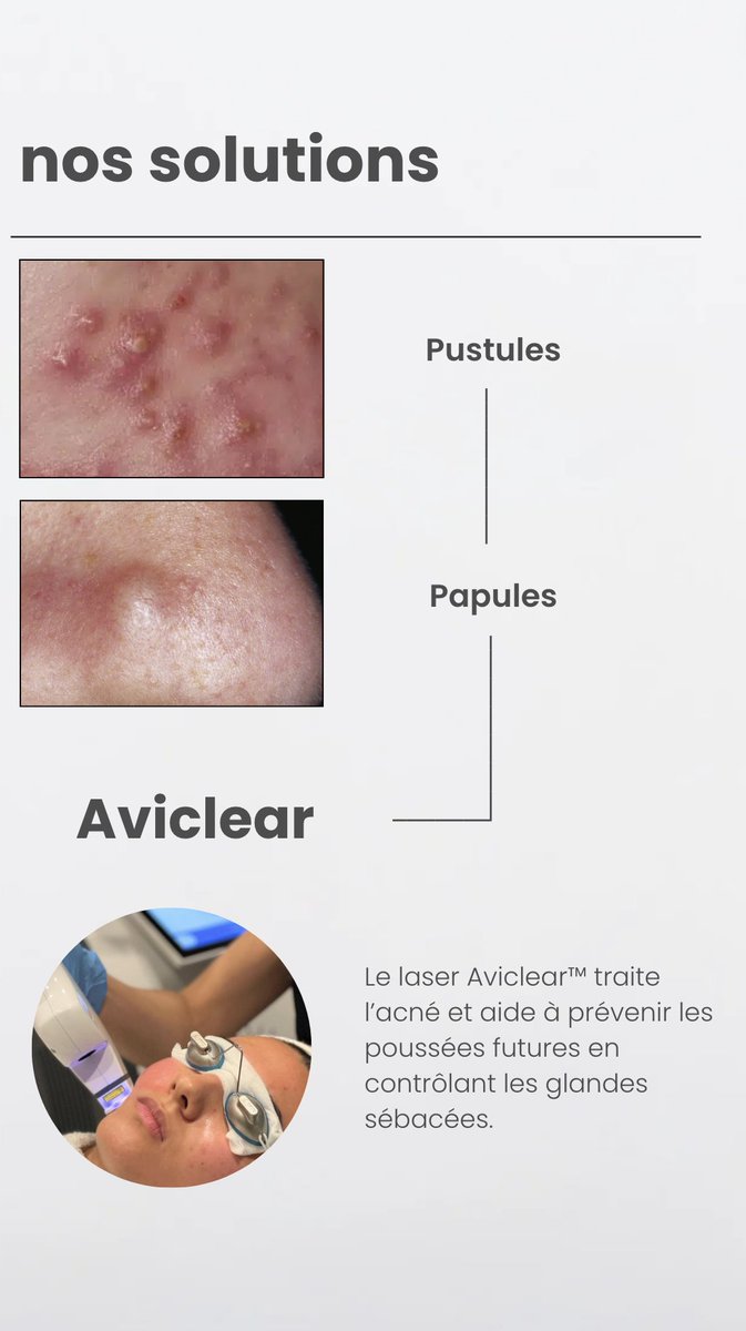 CCELYSEES's tweet photo. #Aviclear de @Cutera pour réduire très fortement les glandes sébacées. https://t.co/NIEI3nLXsG