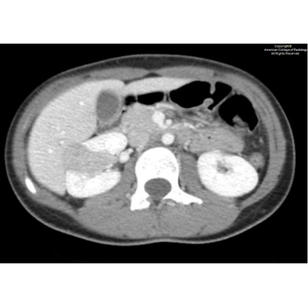 A 16-year-old girl with no relevant medical history presents to the emergency room with a complaint of right flank pain.#ACRCaseinPoint bit.ly/3Jyyypp