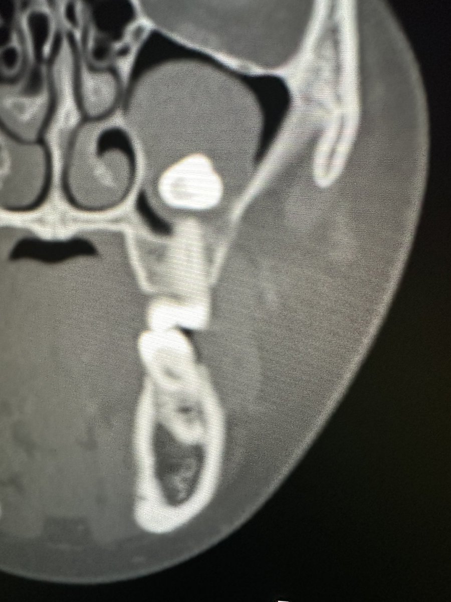 Someone who loves their dental pathology, please give me some education and help us to describe this for a future oral surgeon visit. ED CT done for facial trauma today however.