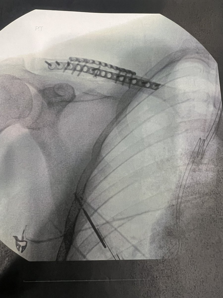 _benacurtis's tweet photo. Unfortunately 5/6 weeks on the sidelines. All systems go to be back for the meet at Colonial🙏🏻
Could say it was unlucky, I’d say I was lucky it was just a collarbone! 
Great lads Hunter &amp; @FaucheuxRacing 
Kept me well entertained 🤝
#PartOfTheJob #LiteralStumblingBlock https://t.co/PgU38GFzPa
