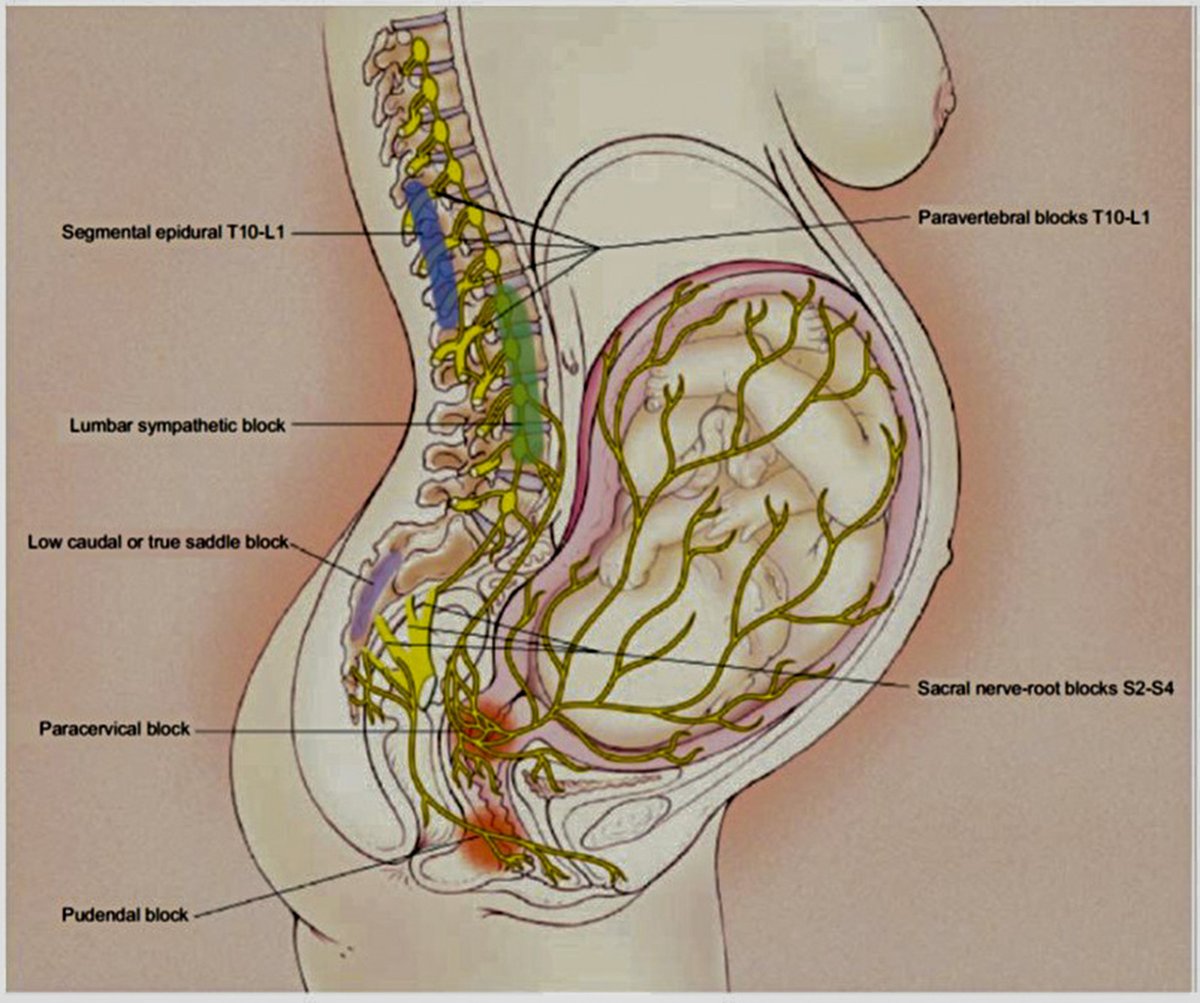 AJOG Expert Review in Labor: Pharmacologic and nonpharmacologic options for pain relief during labor: an expert review - Transmission of labor pain. Labor pain has a visceral component and a somatic component ow.ly/oIc650NTqKu