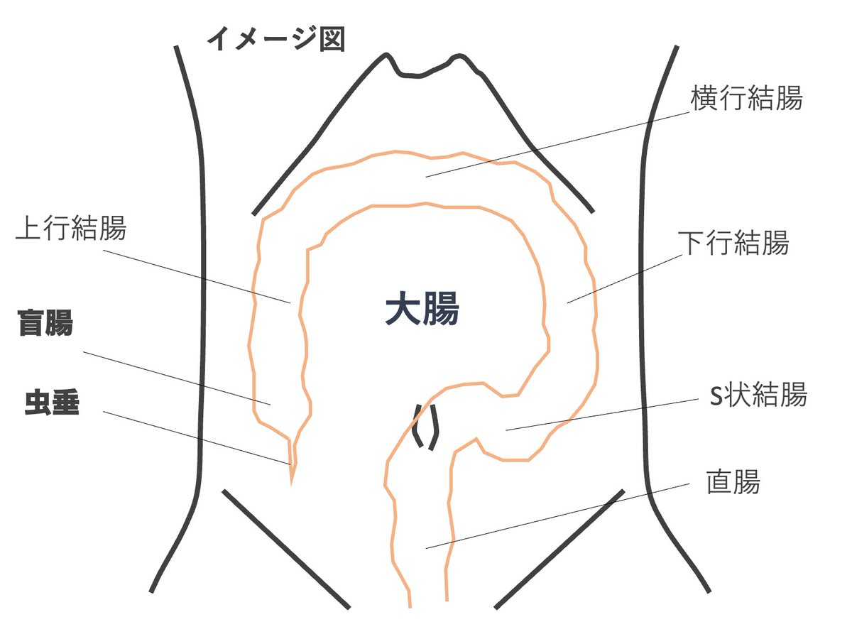 「虫垂は盲腸につながる細い管で、ここに炎症を起こすのが虫垂炎。盲腸は病名ではなく臓器の名前です」 と毎回絵を描いて説明するのですが、難しいのは解剖学的な理解ではなく、何十年もの間「自分は盲腸を切られた」と思っていた方の信念を、初めて会った医師が覆すことが難しいのだと思います。