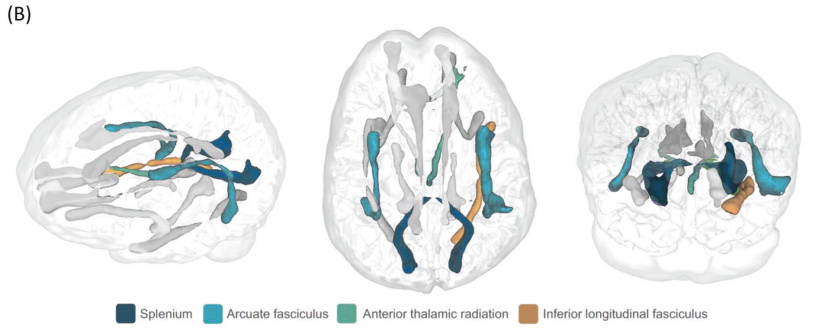 3/4 Additionally, there was evidence of deteriorating white matter tracts, which connect different parts of the brain and are responsible for neural communication.