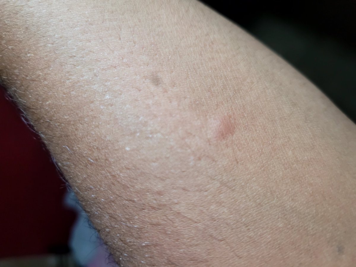 MemoMusic9's tweet photo. "Hey Assam Government, mosquitoes in Assam are throwing parties every night! Can we have a 'No Mosquitoes Allowed' rule? Asking for our sanity and our sleep! #mosquitomayhem"
#assamgovernment #bjp https://t.co/Vrtpp9mdUZ