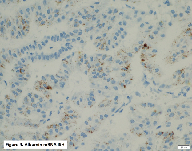 66yr/f hx of a cystic lesion - pancreatic head 5.6 cm. A Whipple procedure was performed and a 5.7cm ill-defined multiloculated cystic mass involving the main pancreatic duct was identified by gross examination.