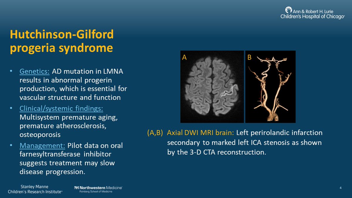 Check out @SMoum's incredible #ASNR24 oral presentation 'Monogenetic Arteriopathies Associated with Pediatric Stroke: What the Neuroradiologist Needs to Know' at 2:50 PM today at the Educational Exhibits Showcase! Here's a sneak peek!

#pedsrad #pedineurorads #imagingourfuture